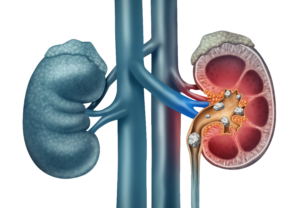 kidney image ritani urology guntur